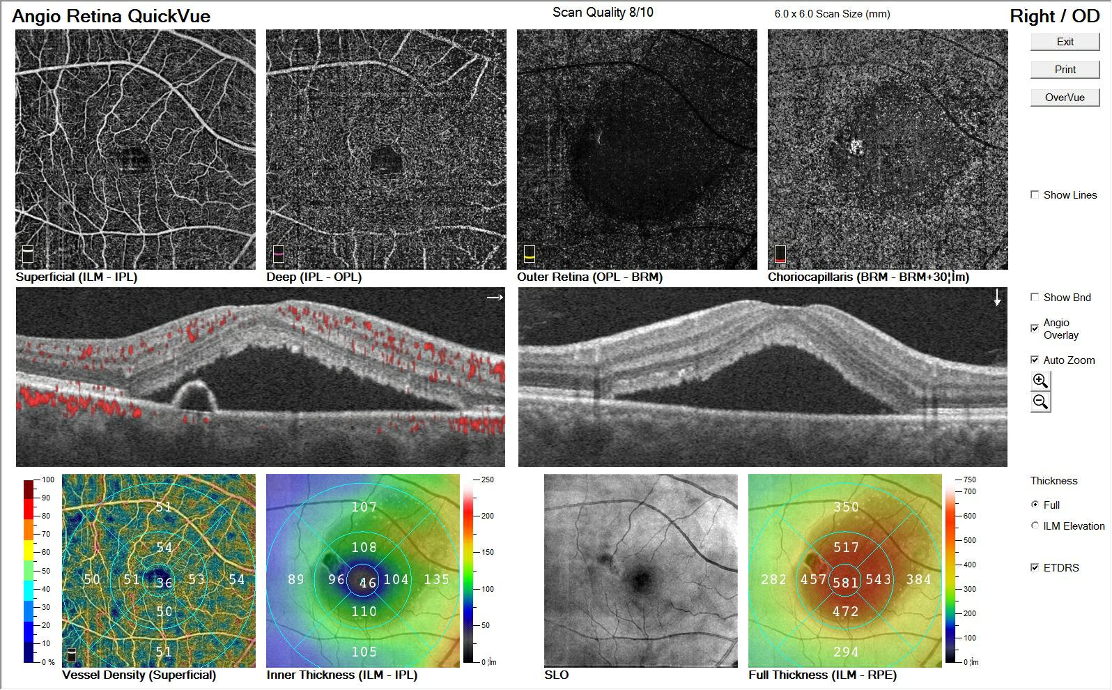 _liu_hui__918_HD Angio Retina_OS_2018-05-24_11-31-37_F_1991-02-04_QuickVue